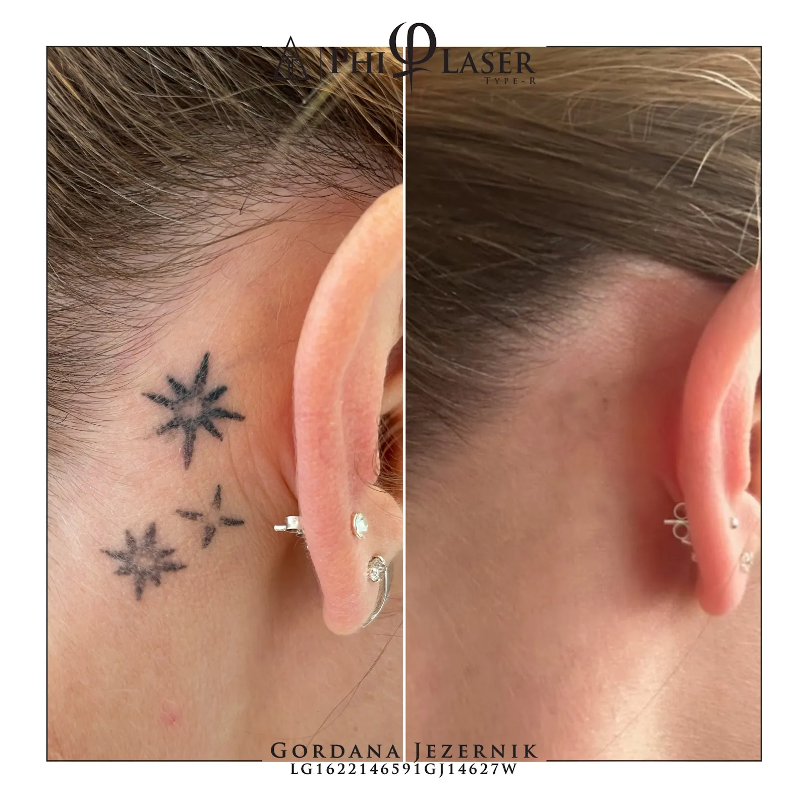 Phi Laser - odstranjevanje tetovaž in permanentnega make upa - fotografija 1